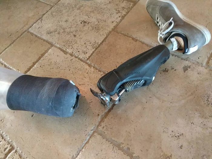 Mi tío se rompió la pierna hoy, dice que no le dolió