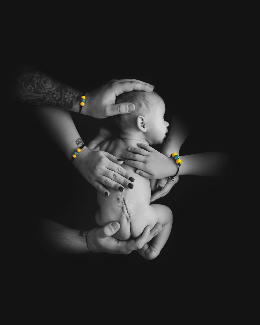 A Powerful Image For Spina Bifida Awareness A Powerful Image For Spina Bifida Awareness