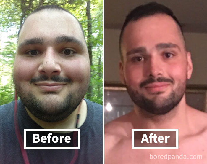 Why Bimax Genio Is Savior Surgery Looksmax Men s Self 