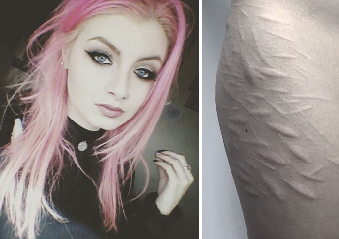 Esta chica de 19 años quería cubrir las cicatrices de sus autolesiones pero todos los tatuadores se negaron a ayudar, excepto uno