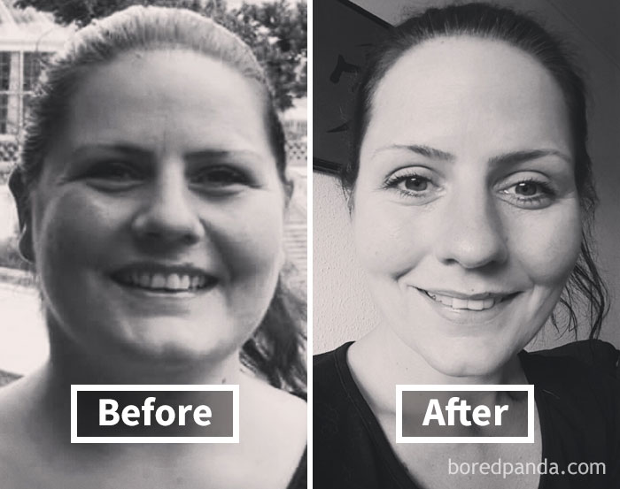 Woman smiling before weight loss and after