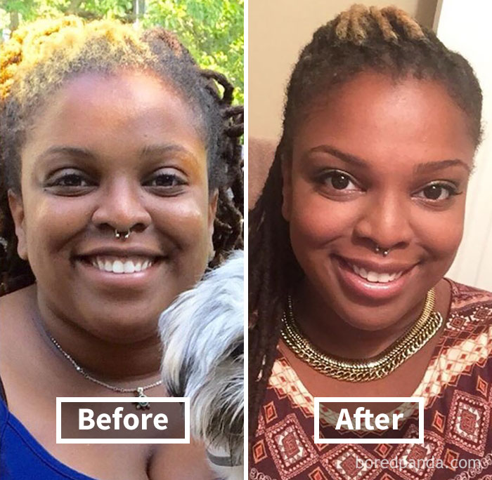 Woman smiling before weight loss and after
