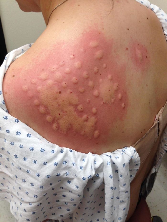 Le han hecho la prueba de la alergia a mi hermana y es alérgica a TODO lo que le pusieron. Lo peor, a los caballos