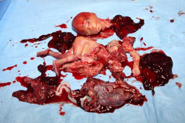 abortion-murders-5a6a4ff78126f.jpg