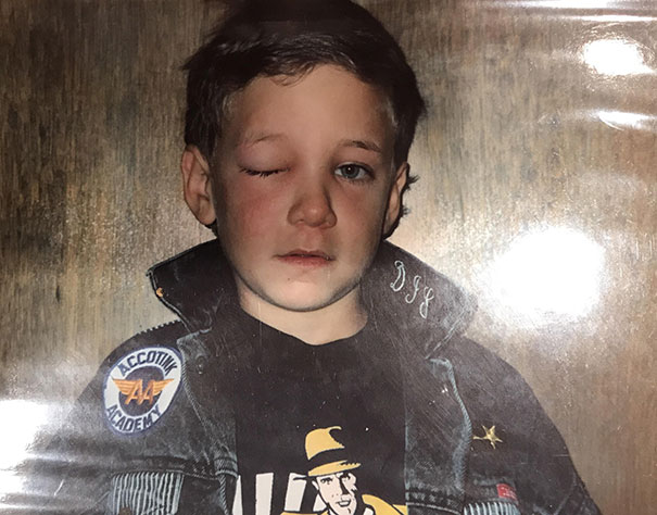 My Father Took A Picture Of Me After My First Girlfriend Punched Me In The Eye, 1991