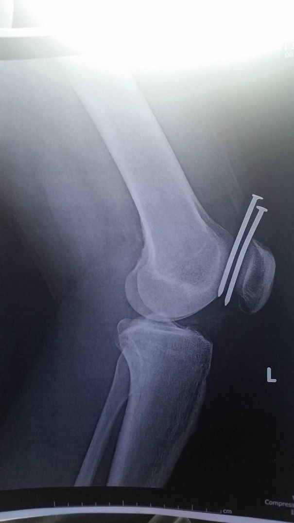 This Guy Had Two Nails From A Nail Gun Hit His Leg, And They Both Missed His Femur And His Kneecap