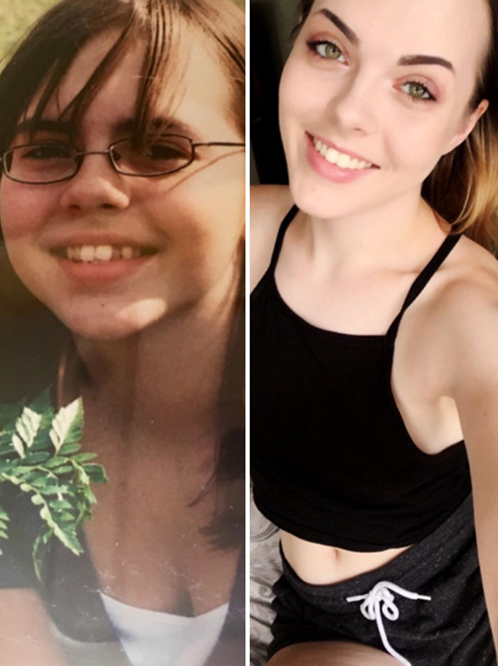 12 To 21. Weight Loss And A Set Of Braces Later, I Am Still An Insecure Person, But I Feel Much More Comfortable In My Body
