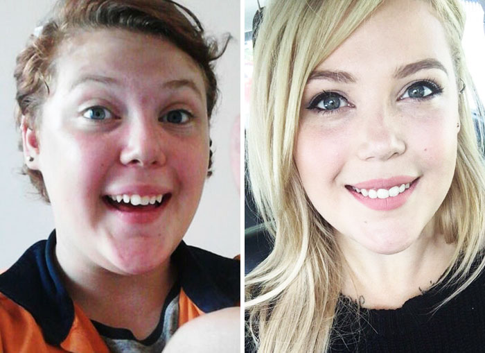 People Who Used To Be “Ugly Ducklings” Share Their Transformations, And We Can Barely Recognize Them (New Pics)