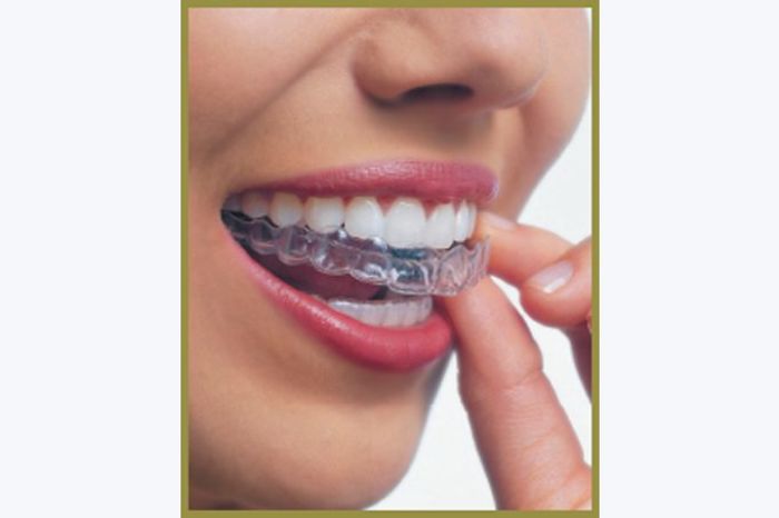 Five Tips For The Best Invisalign Experience Five Tips For The Best Invisalign Experience