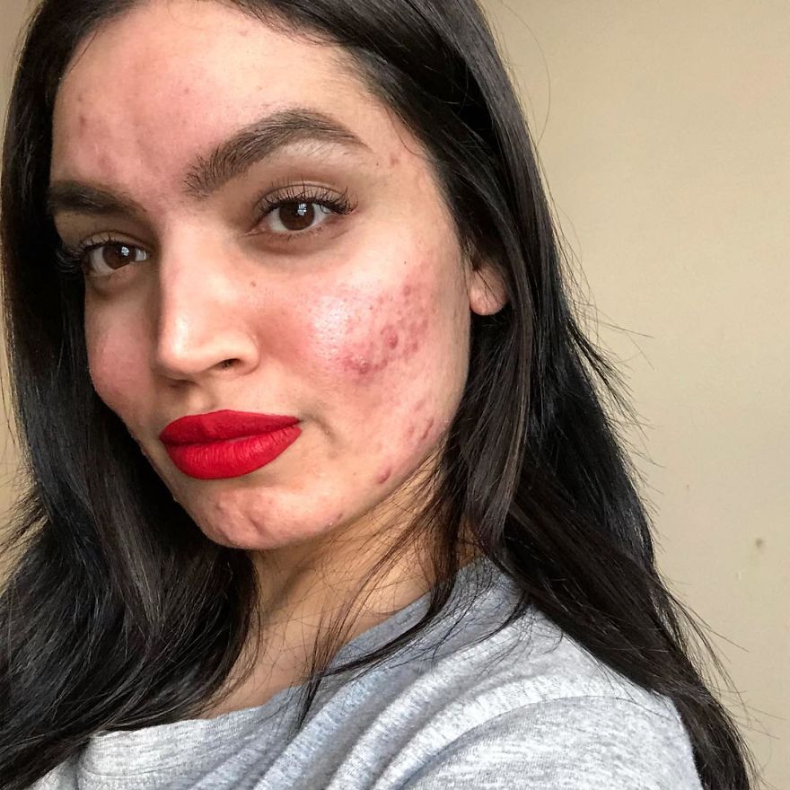 Woman Gets Dropped From L’Oréal's Campaign Because Of Her Acne, She Responds With A Powerfull Message