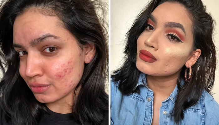 Woman Gets Dropped From L’Oréal’s Campaign Because Of Her Acne, She Responds With A Powerfull Message