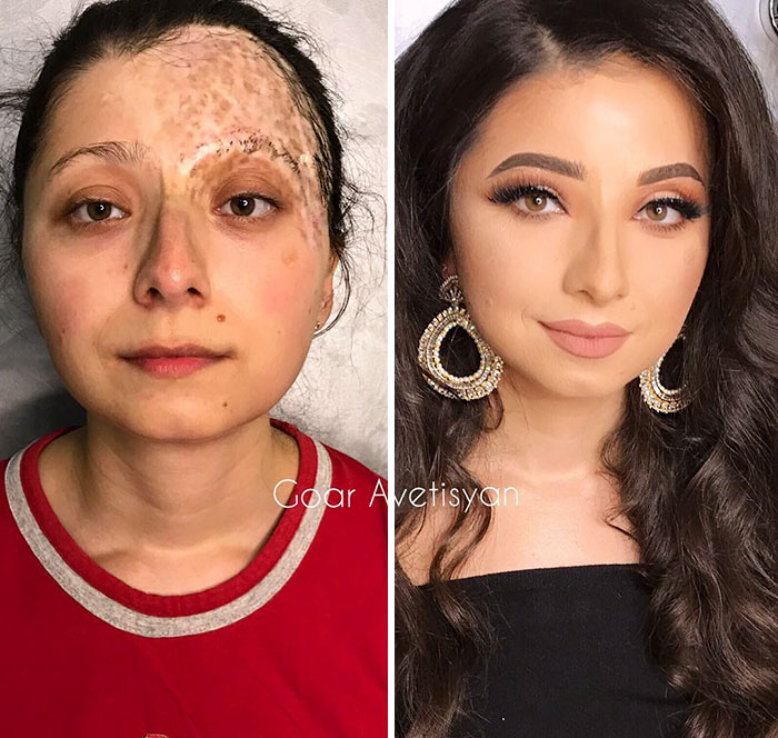 Lily Went Through Two Skin-Transplant Operations Because Of Her Birthmark. Goar Succeded In Covering Up Her Scars To Make Her Feel Gorgeous On The Inside And Out