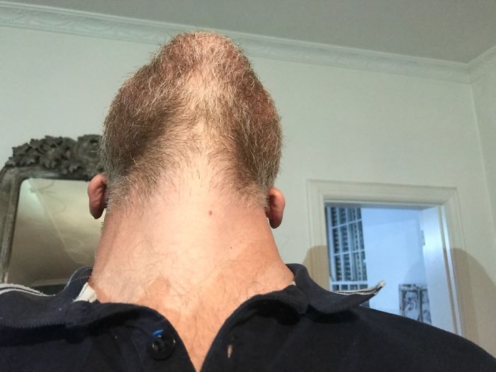 Male Pattern Baldness?