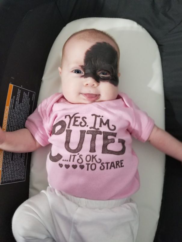 This Baby Was Born With A Birthmark Which Turned Her Into "Little Superhero"