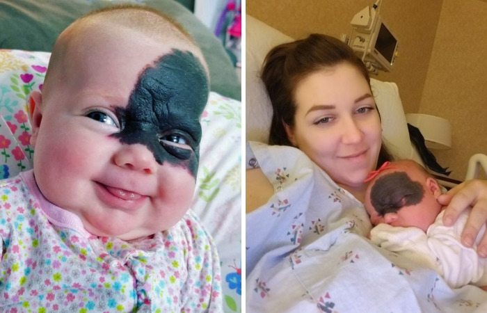 This Baby Was Born With A Birthmark Which Turned Her Into “Little Superhero”