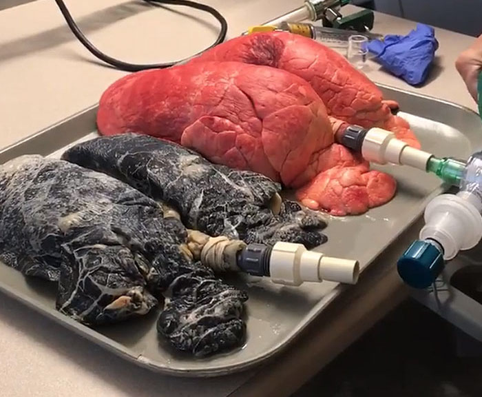 Shocking Video Of Nurse Inflating Healthy Lungs Vs Smoker's Reveals What Cigarettes Really Do To You