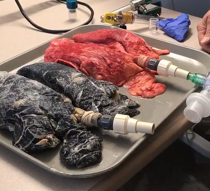 Shocking Video Of Nurse Inflating Healthy Lungs Vs Smoker's Reveals What Cigarettes Really Do To You