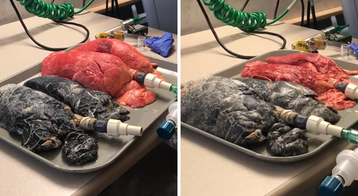 Shocking Video Of Nurse Inflating Healthy Lungs Vs Smoker’s Reveals What Cigarettes Really Do To You