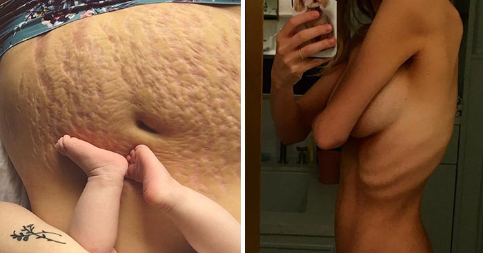 90 Brutally Honest Photos Of Post-Baby Bodies, That Women Are Sharing To Reveal The Truth No One Talks About