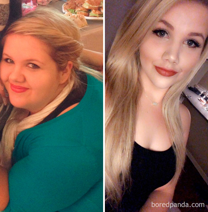 101 Lbs Lost. You Could See Facial Progress As Well