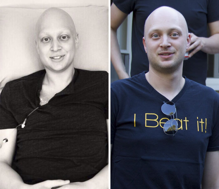 My Husband Is Five Years Cancer Free! Right: Last Night (!), Left: His Last Chemotherapy Session For Ewing's Sarcoma (52 Weeks Of Treatment)