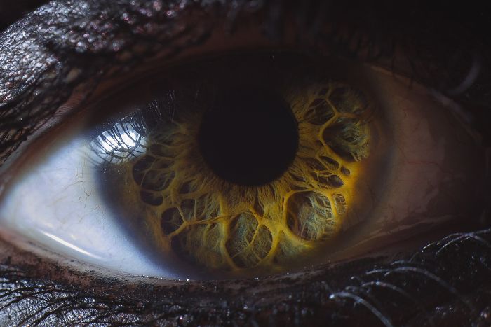 6 Years Ago I Posted My Wife's Eye That Her Doctor Told Her Was The Weirdest He'd Ever Seen. Since Then My Photography's Improved Quite A Bit, So Here's A New Pic I Took A Couple Days Ago