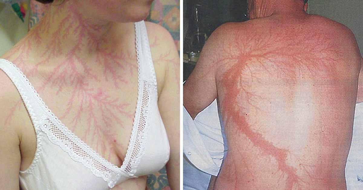 19 Personas que sobrevivieron tras caerles un rayo muestran lo que causa en tu piel