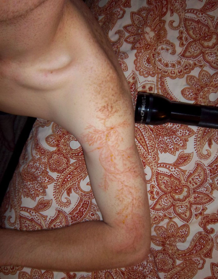 Lichtenberg Scars — Nature’s Tattoo You Don’t Want To Have