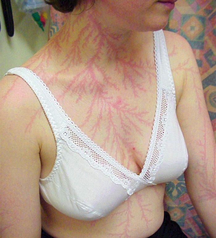 Cicatrici-Dopo-sopravviventi-fulmini-strike-Lichtenberg-Figure-Foto-18
