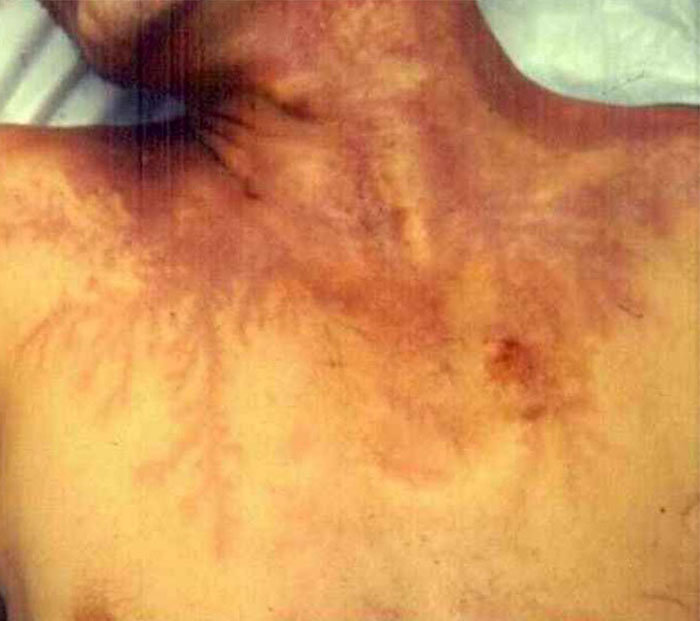 Lichtenberg Scars — Nature’s Tattoo You Don’t Want To Have