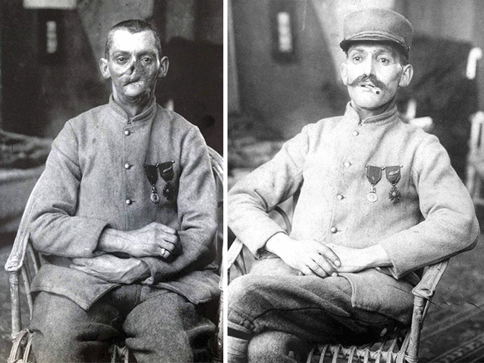 Fascinating Before & After Pics Show How This Woman Changed Lives Of WWI Veterans By 'Restoring' Their Faces