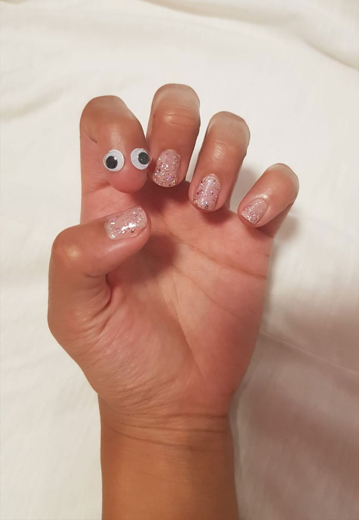 My GF Was Born Without A Nail On A Finger. We Put Googly Eyes On It