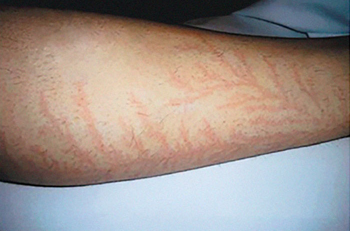 19 People Who Survived Getting Struck By Lightning Show What It Does To Your Skin