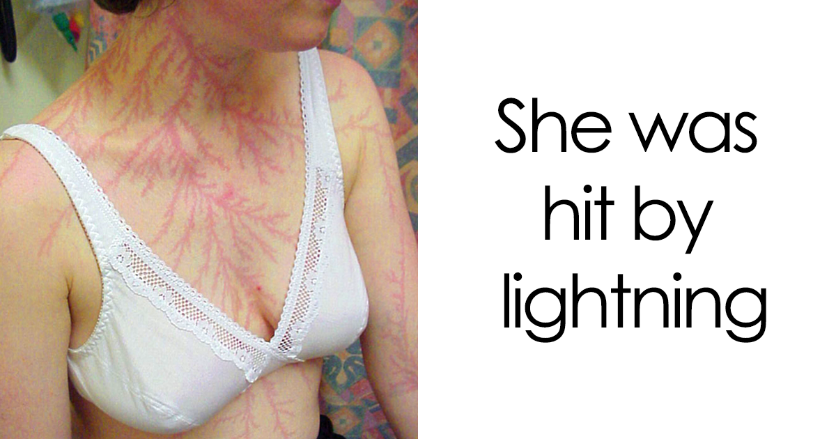 Here's What Scars Of Being Struck By Lightning Look | Bored Panda