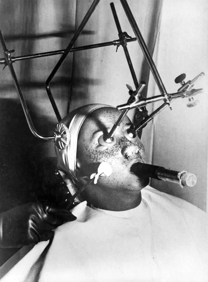 Odstránenie pihy. Je použité komplikované zariadenie. Oči sú zakryté špeciálnym, vzduchotesným kúskom a nozdry sú vyplnené. Dýchanie sa vykonáva prostredníctvom špeciálnej trubice. Citlivé časti tváre sa musia ošetrovať osobitne, 1930