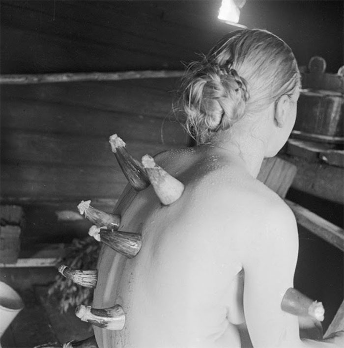 A Form Of Folk Medicine Called Cupping Therapy Being Performed In A Sauna, Finland, 1935