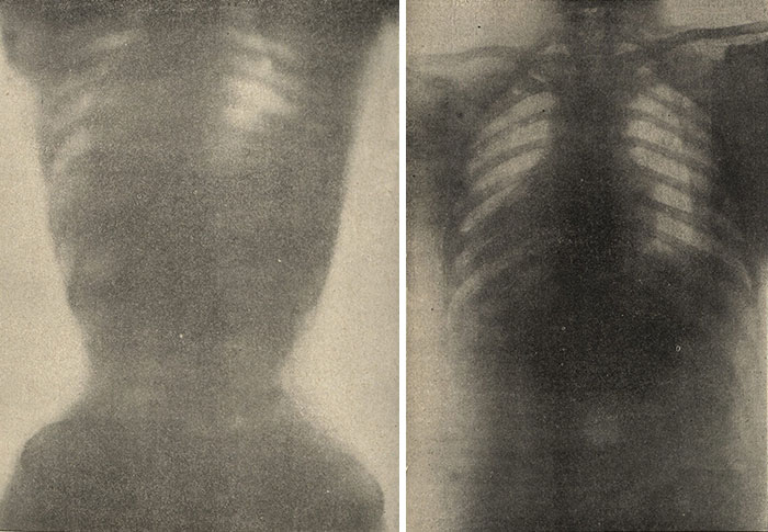 Rayos X de torso femenino con corsé y sin corsé, 1908