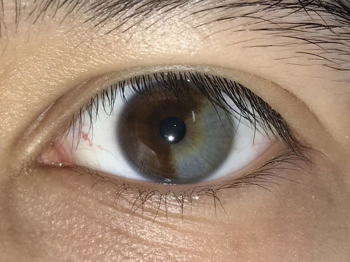 Mi ojo izquierdo es 1/3 gris