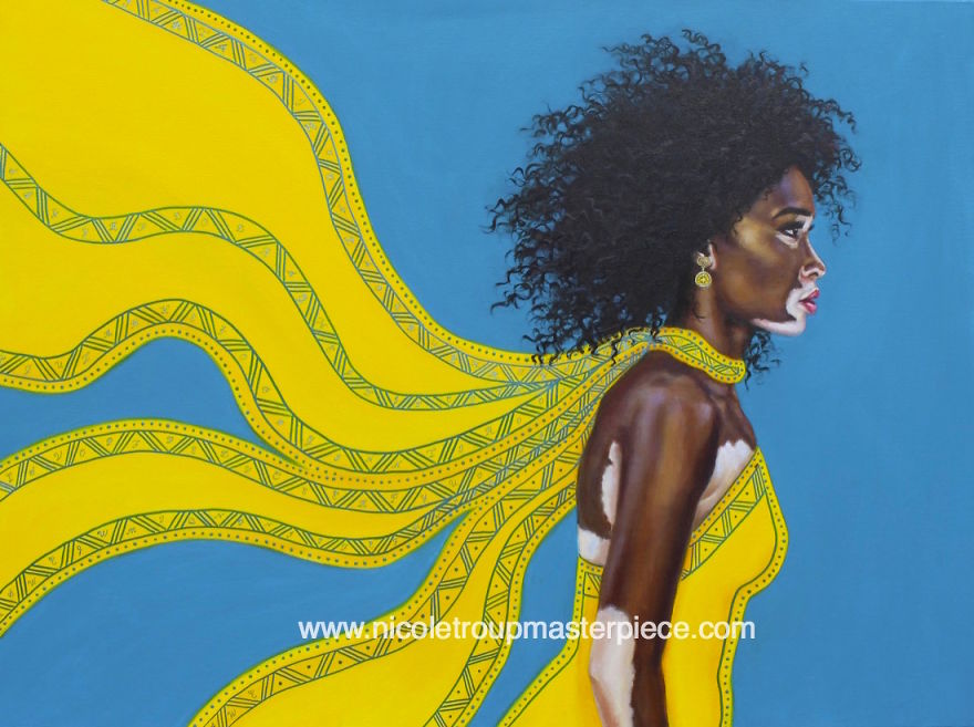 Vitiligo Beauty Vitiligo Beauty