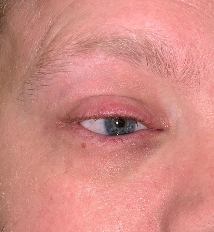 7 Months Ago My Husband Lost His Eye, I Documented The Weekend When He Finally Got A New One (Warning: Sensitive Content)