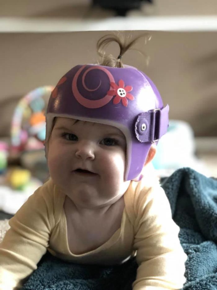Jillian Had Her Helmet For 3 Months And Just Graduated Last Week! Thank You For Posting A Picture Of Your Sweet Boy In His Helmet To Bring Awareness!