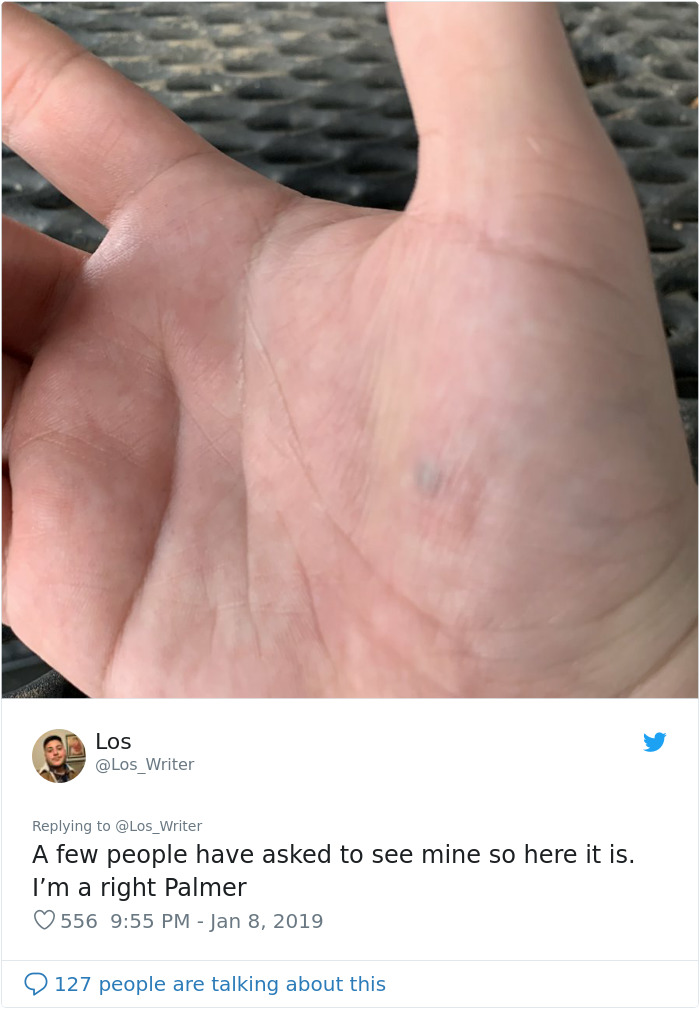 Apparently, Pencil Scars Are A Thing And There Are More People Affected Then You Would Think