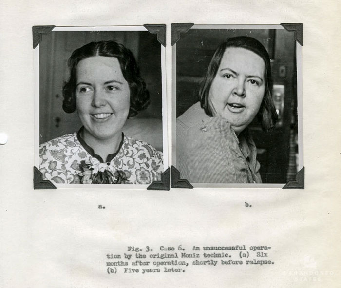 Before-After-Lobotomy-Surgery-Patients-Photos