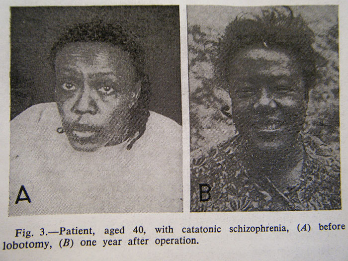 These 21 Before And After Photos Of People Who Underwent Lobotomies Are Disturbing