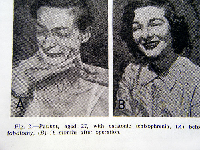 Before-After-Lobotomy-Surgery-Patients-Photos