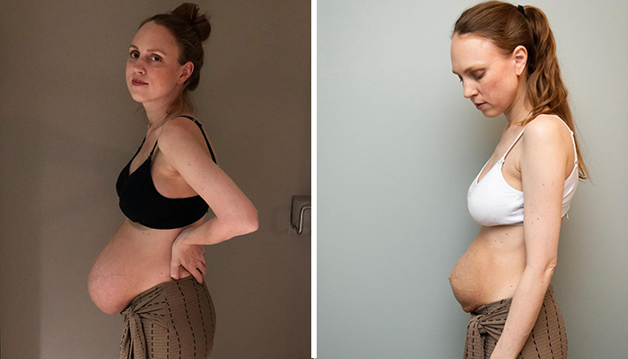 Woman Who Stunned The World With Her Huge Baby Belly, Shows What Giving Birth To Triplets Does To Your Body