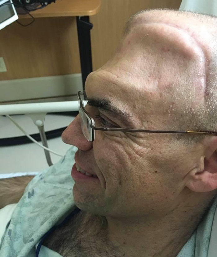 Guy Who Was Supposed To Live For 6 Years After Brain Cancer Diagnosis, Lives For 20+ Years, Beats It 4 Times