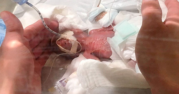 Tras pasar meses en el hospital, el bebé prematuro superviviente más pequeño del mundo al fin ha recibido el alta