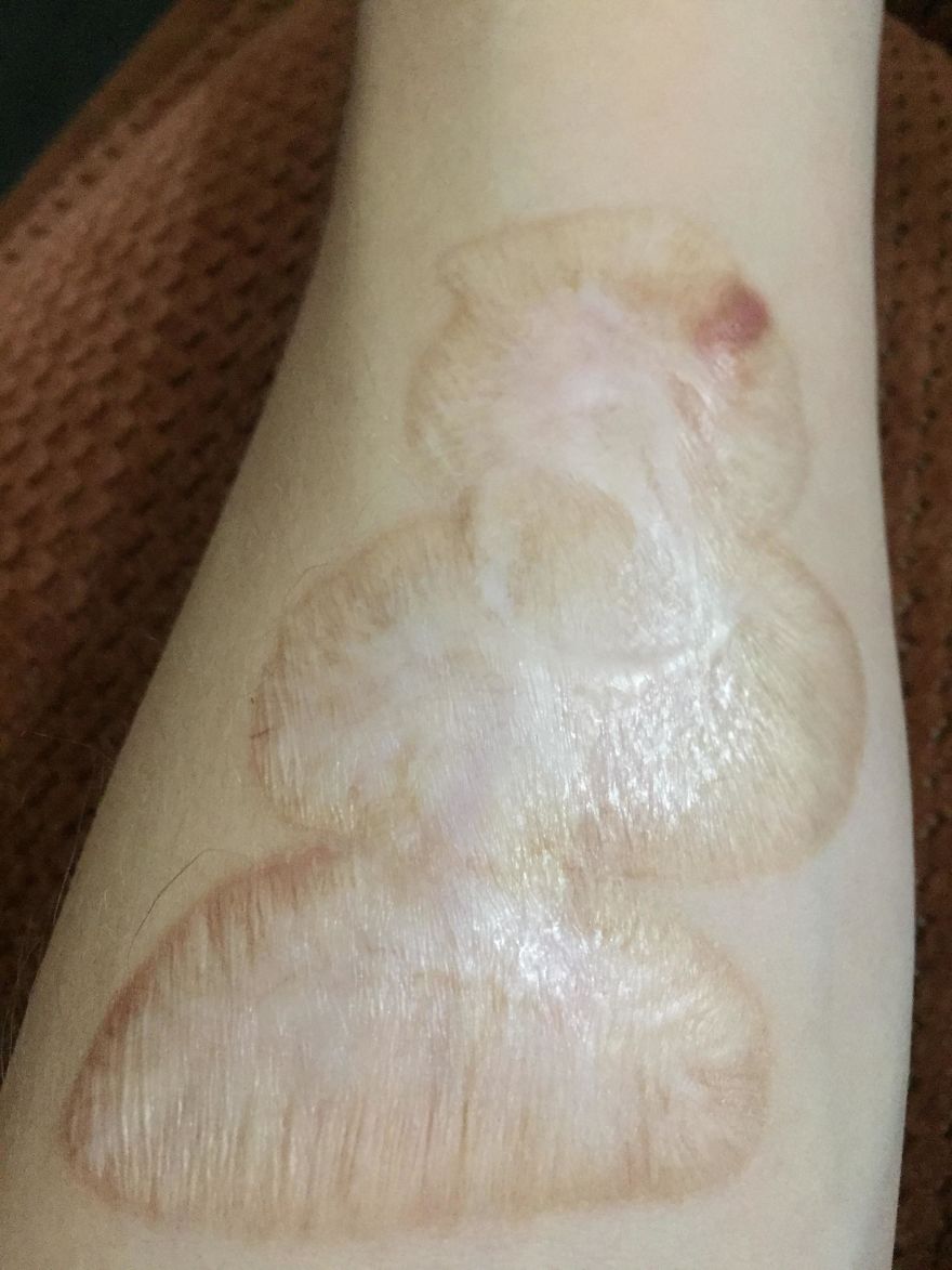 Hide Scar By Tatto Hide Scar By Tatto