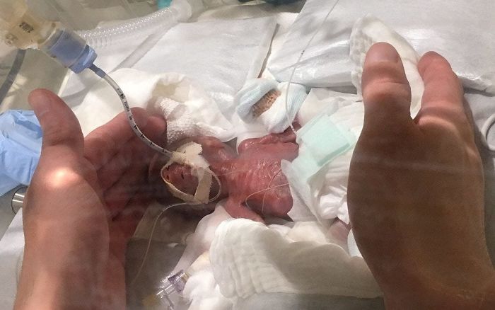 A Boy Born Weighing 268 Grams (9.45 Oz) Was Sent Home Healthy After Months In The Neonatal Care Unit In Tokyo. He's The Smallest Child To Ever Be Born And Survive